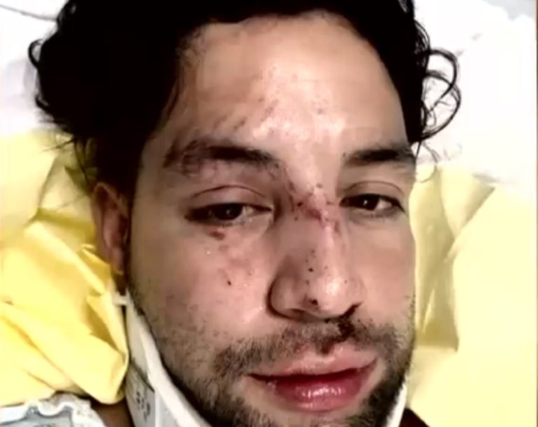 Joven chileno sufre brutal agresión en Miami: Acusa ataque homofóbico