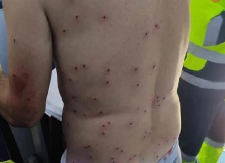 Ciclista fue herido con 100 perdigones: Cazador lo confundió con un conejo