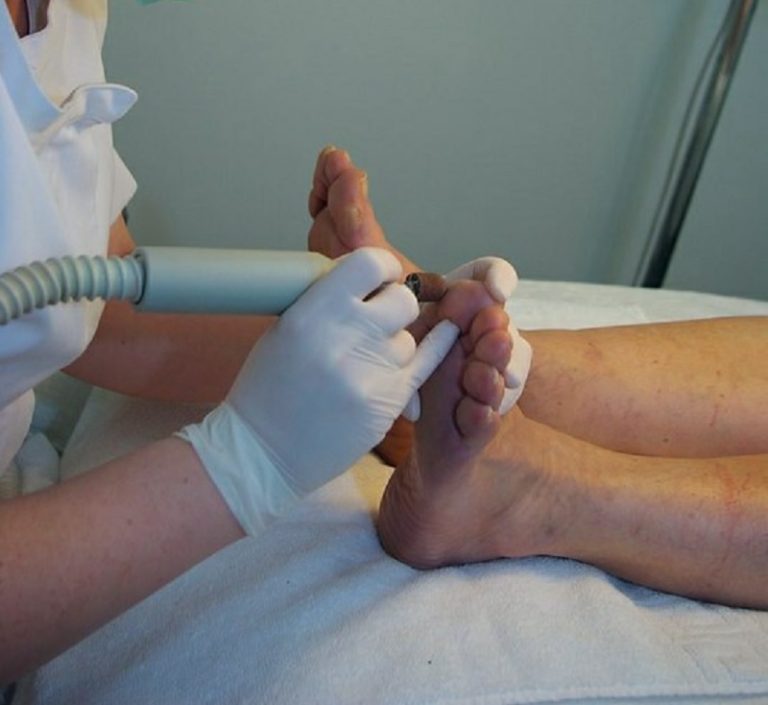 Mujer se infectó tras una pedicura y terminó con una pierna amputada