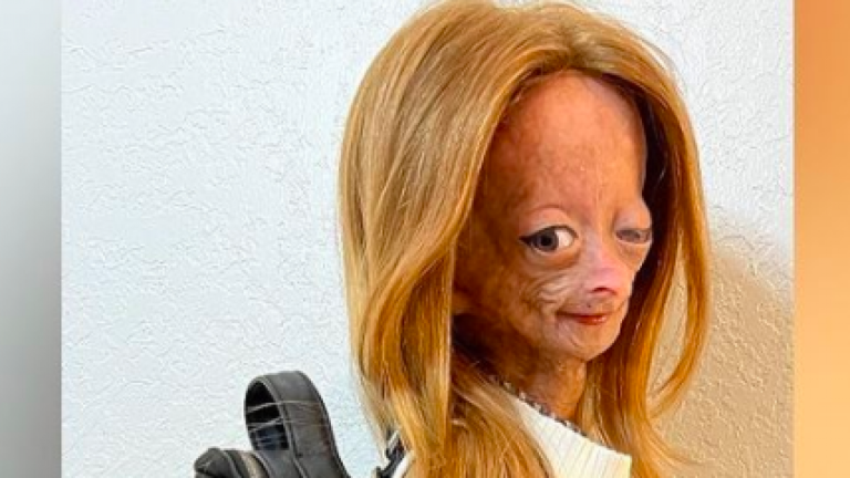 Adalia Rose Williams: A los 15 años murió youtuber que inspiró la película de Benjamin Button