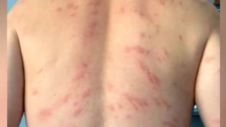 Balneario fue cerrado: Extraña reacción alérgica en laguna de Quillón