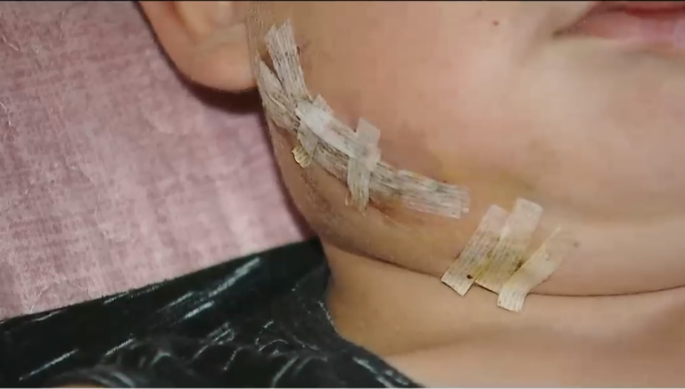 Niño de 6 años quedó gravemente herido tras ataque de dos perros rottweiler