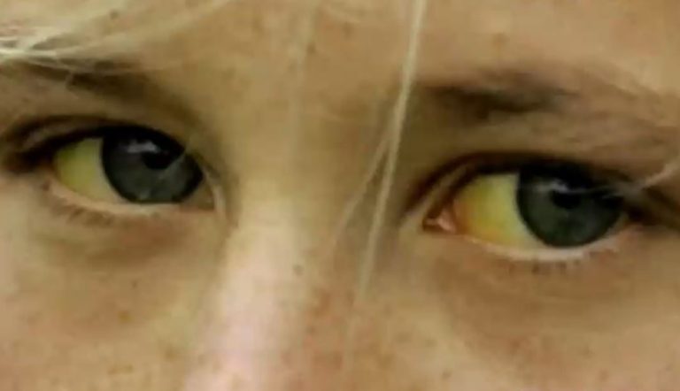 Alerta por casos de hepatitis aguda infantil: Gastroenterólogo explicó los síntomas a estar atentos