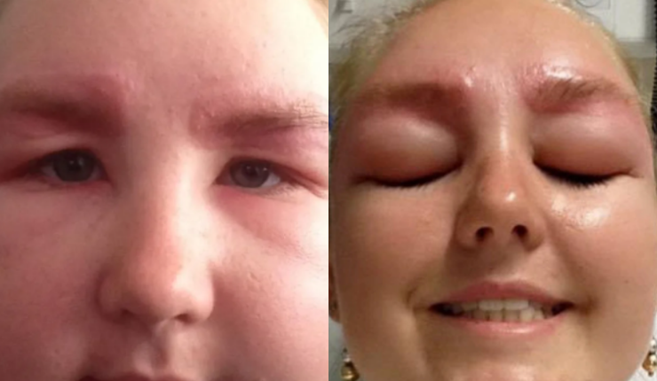 La grave reacción alérgica que le provocó teñirse las cejas: 