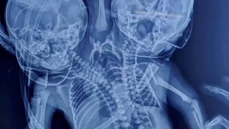 ¡Caso insólito! Mujer esperaba dar a luz mellizos pero nació un bebé con dos cabezas