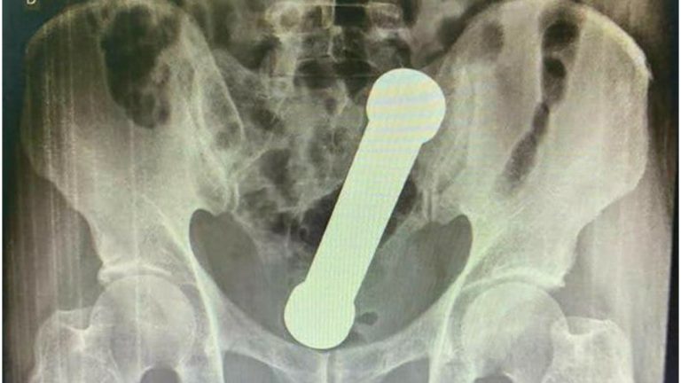 ¡Insólito caso! Encuentran una mancuerna de dos kilos en el recto de un hombre