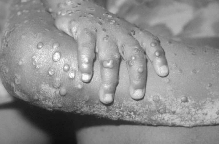 Viruela del mono: ¿Qué se sabe de la enfermedad zoonótica que mantiene en alerta al mundo?