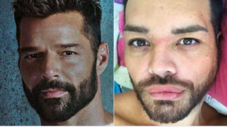 ¡Se realizó más de 20 cirugías! Ex chico reality se operó para parecerse a Ricky Martin