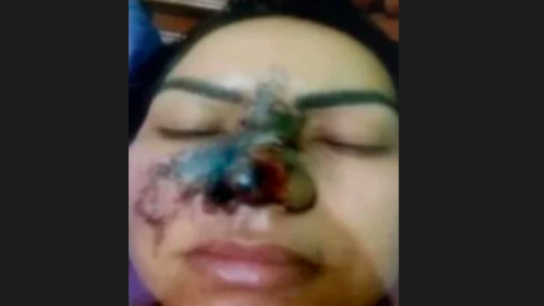 ¡Quedó su rostro deformado! Mujer se operó la nariz con un dentista que encontró en internet