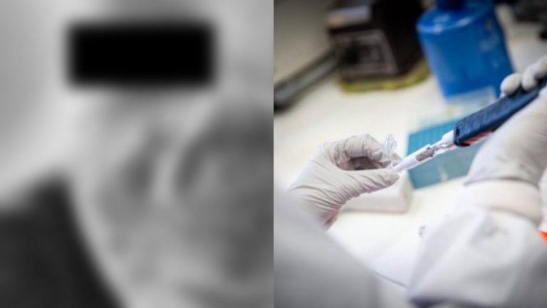 Los impactantes efectos de la viruela del mono en un paciente de 40 años: Presentó necrosis en su nariz