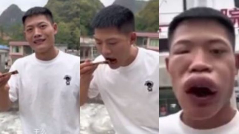 Influencer se comió una avispa viva para sumar seguidores en TikTok y terminó con su cara deformada