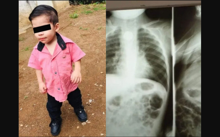 Guagua tragó accidentalmente una pila: Está grave, con daños en esófago y pulmones