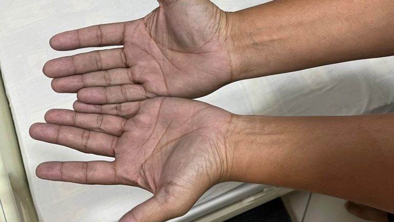 Parece chiste, pero no: Médico viraliza insólita historia de paciente que acudió asustado por sus manos azules