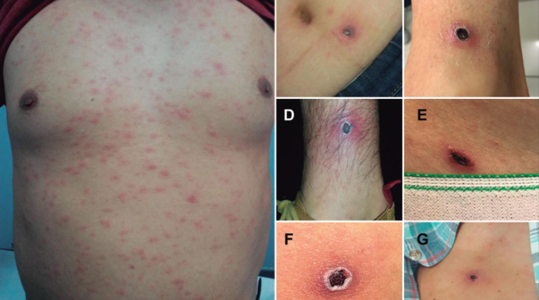 Detectaron primer caso en Aysén: ¿En qué consiste y cuáles son los síntomas del 