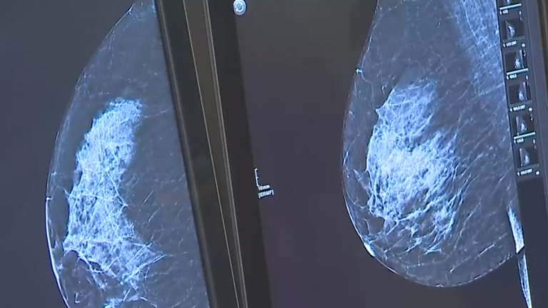 Comenzó a regir la normativa que permite el acceso gratuito a mamografías sin orden médica