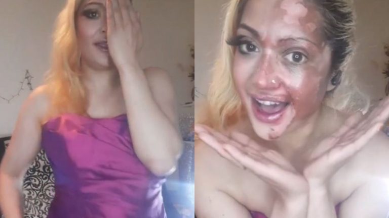 Quiso cocinar un huevo en el microondas y provocó una explosión que quemó su rostro: Así quedó tras el accidente