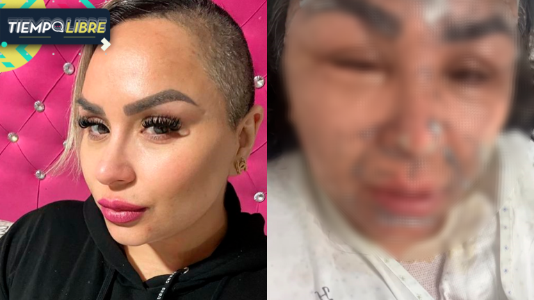 “Oren por mí”: La dramática petición de titkoker chilena que sufrió graves quemaduras en su rostro