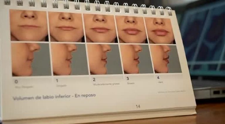 El boom de chilenas operándose en Mendoza: Precios bajos son el principal 