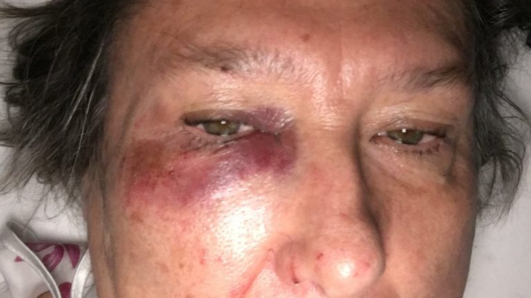 Acusan al Municipio de Providencia de no responder ante caída de adulta mayor en la comuna