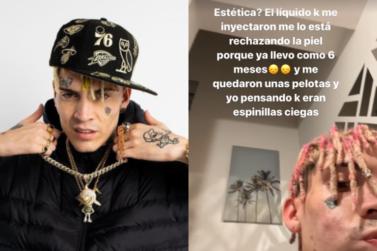 Marcianeke sufrió compleja reacción tras procedimiento estético: 