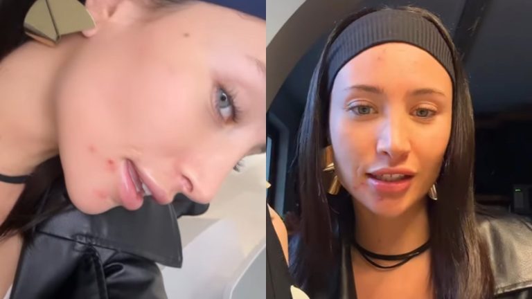 Maite Phillips mostró los resultados definitivos de su retoque estético: 