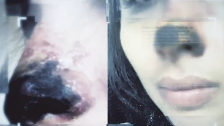 Alertan sobre riesgos tras intervenciones estéticas con ácido hialurónico