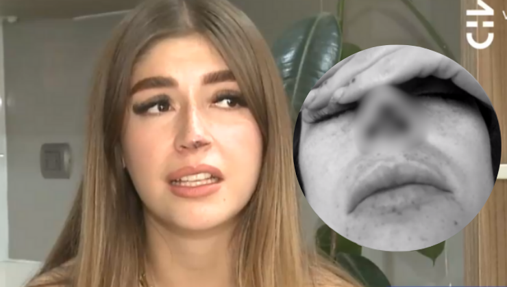 Joven relató brutal ataque por parte de ex pololo: Le mordió y arrancó un pedazo de nariz