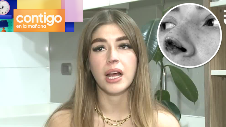 ¡Impactante! Joven denuncia que ex pololo la agredió y mordió su nariz