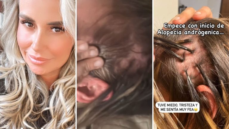 Ex chica Mekano mostró los avances de su tratamiento contra la alopecia androgenética