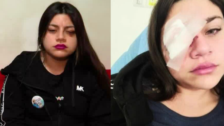 “Nadie me ha contactado”: Crudo testimonio de joven que perdió un ojo tras arengazo colocolino