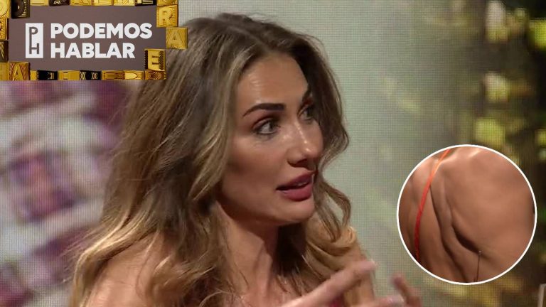 Carola de Moras reveló que perdió un pulmón a los ocho años: Mostró cicatriz de la operación