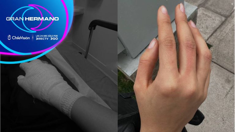 “Me quemé, pero...”: Cony Capelli mostró su mano tras accidente con aceite hirviendo