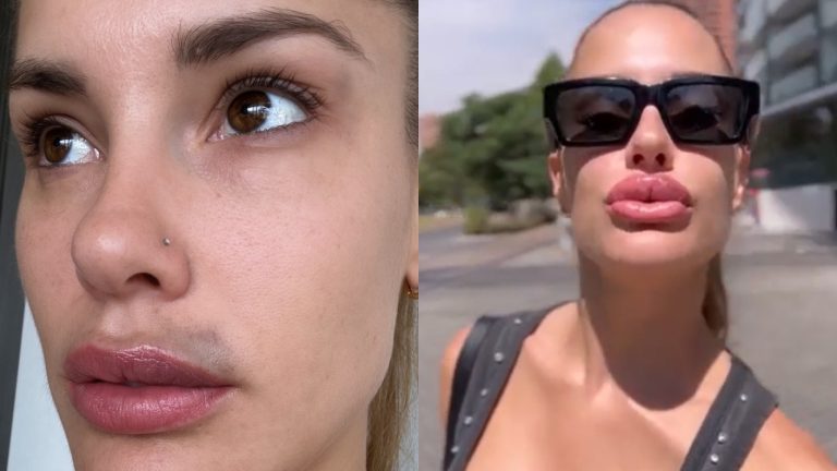 Gala Caldirola impactó con resultado de procedimiento estético: “Año nuevo, labios nuevos”