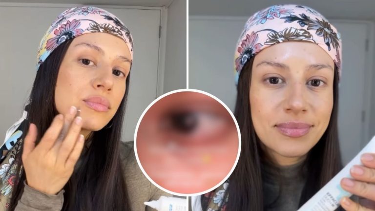 “Duele”: Karla Melo mostró los efectos de la quimioterapia en su cuerpo
