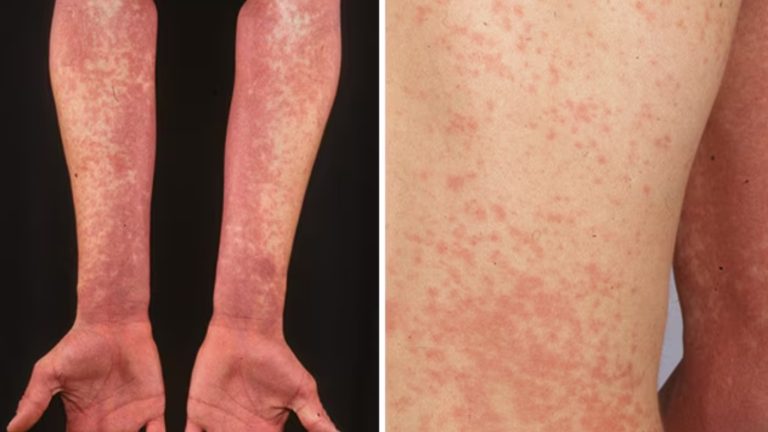 ¿Qué es la fiebre escarlata que hizo suspender clases en Talca? Principales síntomas y riesgos