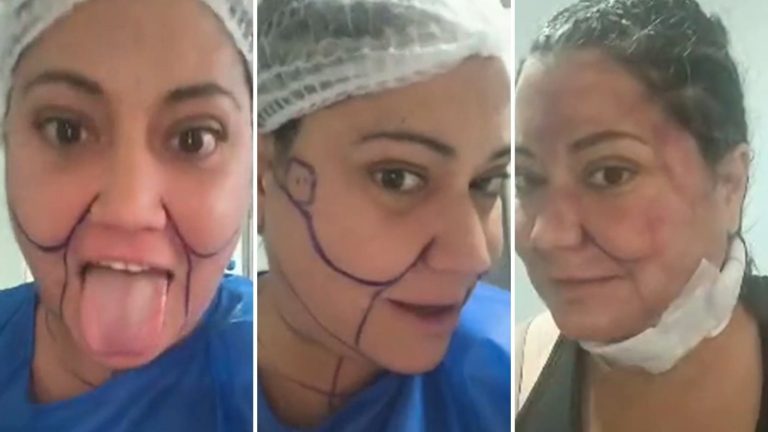 “Se van a morir”: Estos son los 6 procedimientos estéticos que se hizo Denisse Campos