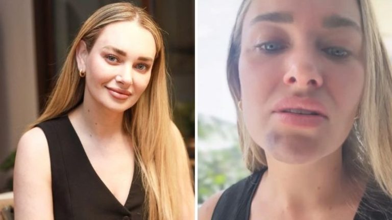 Daniela Nicolás muestra cómo quedó su rostro tras accidente casero: “Se me deformó la cara”