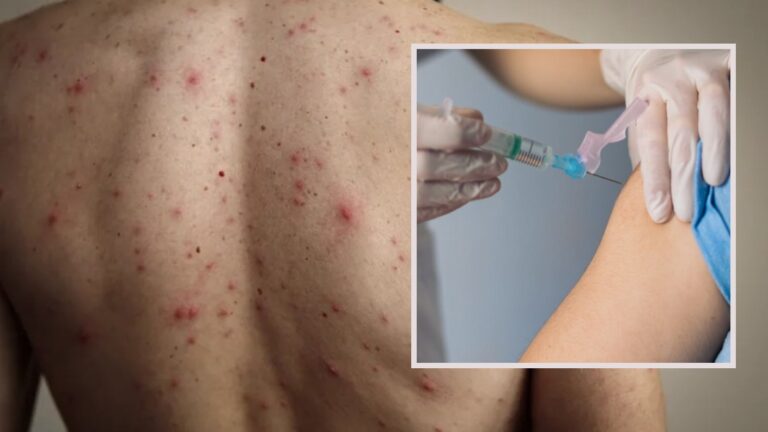 Minsal confirma caso importado de sarampión en la región Metropolitana