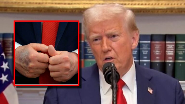 ¿Una enfermedad le está causando moretones a Donald Trump? Esta es la explicación oficial