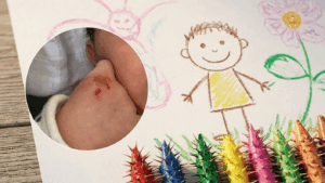 “La Niñez no debería doler”: Fundación DEBRA inicia campaña de nuevos socios para apoyar a niños con Piel de Cristal
