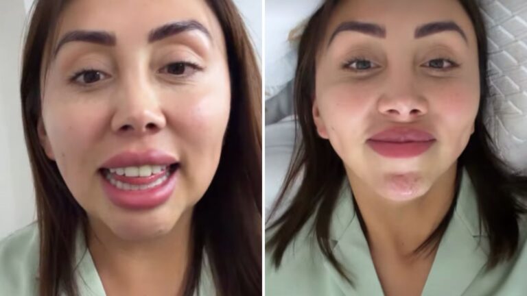 Naya Fácil mostró el antes y después de su operación en redes: 